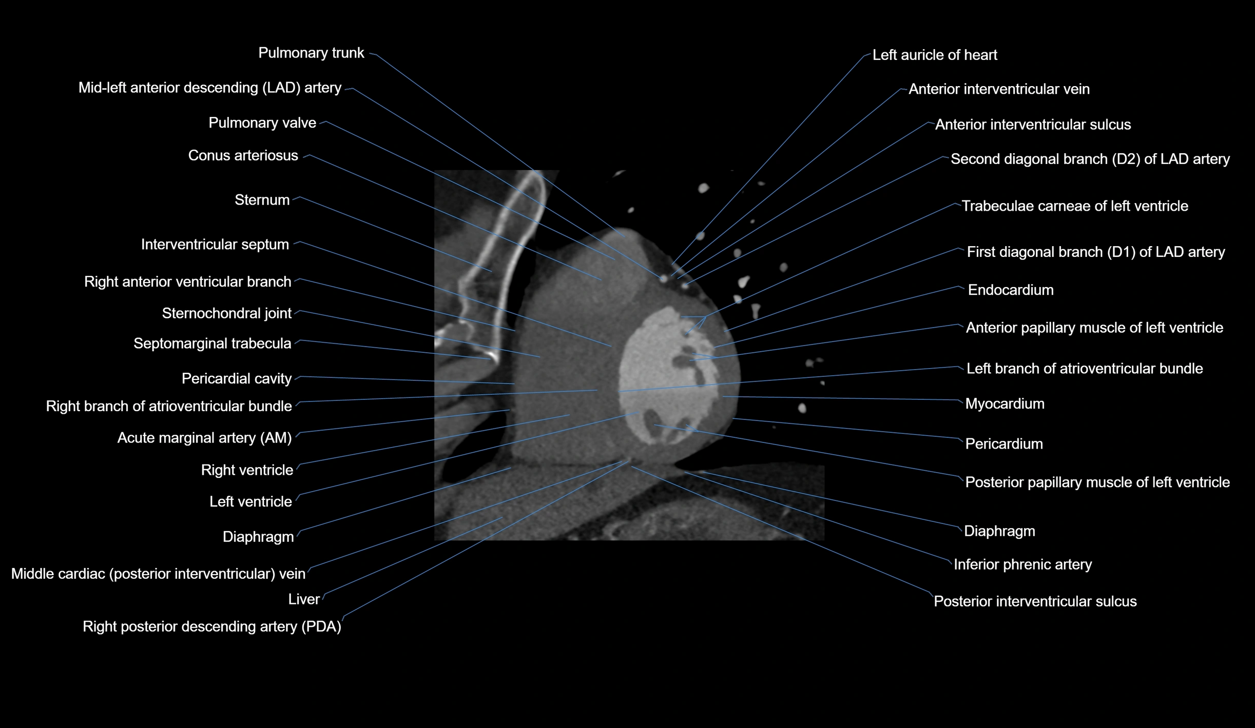 CT heart (coronary angiogram) short axis view  cross sectional anatomy labelled radiology image-00032.webp
